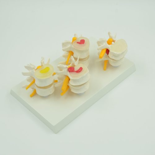 4-STAGES DISEASED VERTEBRA MODEL