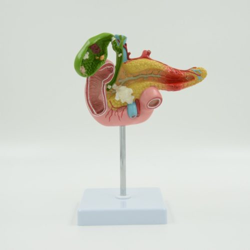 PATHOLOGICAL MODEL OF THE PANCREAS ,DUODENUM AND GALLBLADDER
