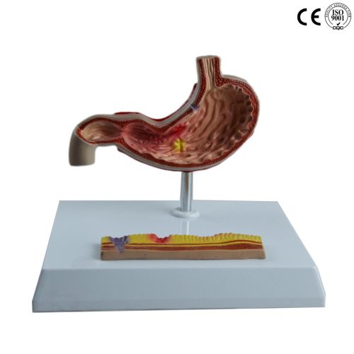 DISEASED STOMACH MODEL