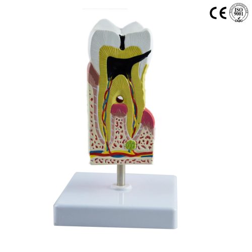 DISEASED TOOTH MODEL WITH BASE