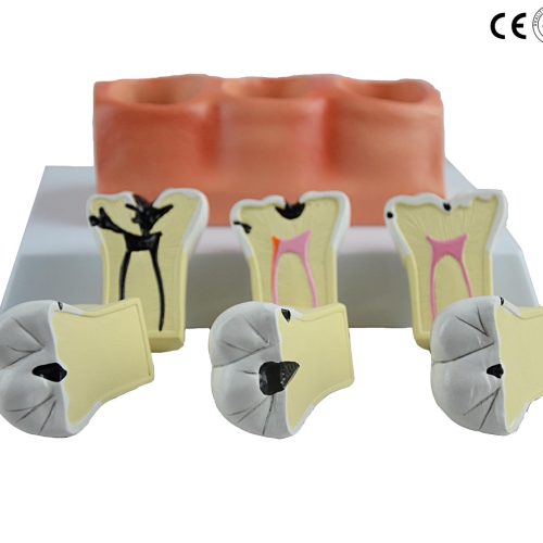 STAGED MODEL OF DECAYING TOOTH