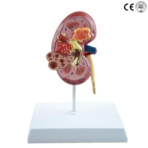 DISEASED KIDNEY MODEL