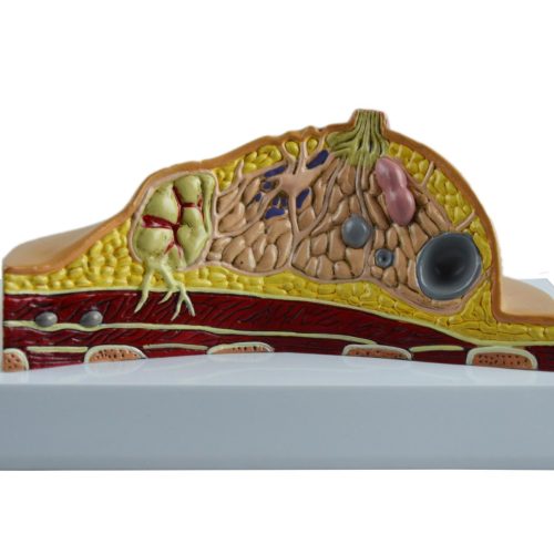 DISEASED BREAST MODEL