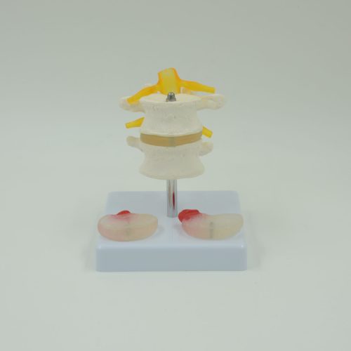 2 LUMBAR VERTEBRA WITH HERNIA AND PROLAPED INVERTEBRAL DISC