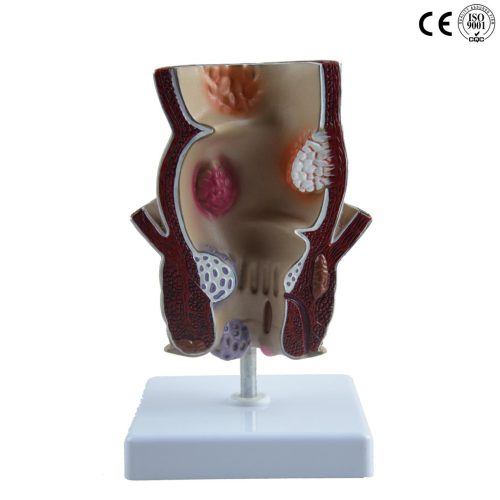 PATHOLOGICAL MODEL OF THE RECTUM